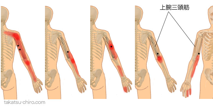 上腕三頭筋のトリガーポイント関連痛領域