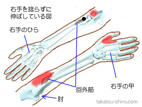 回外筋のトリガーポイント関連痛領域