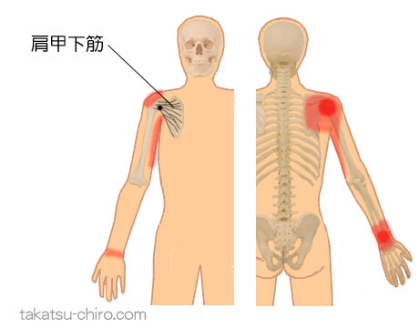 肩甲下筋のトリガーポイント関連痛領域