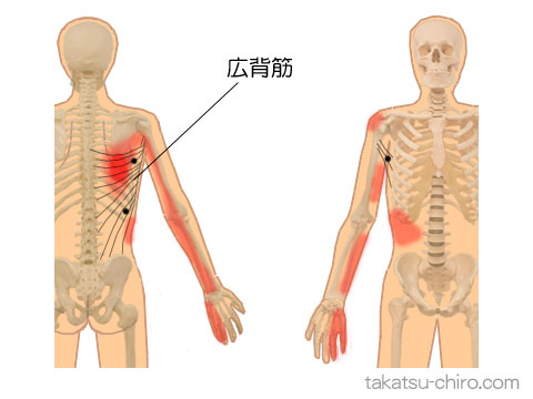 広背筋のトリガーポイント関連痛領域