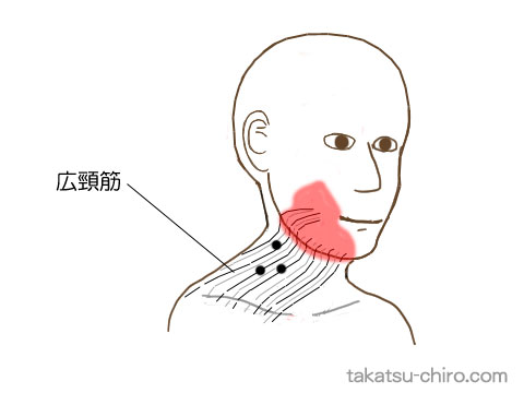 広頸筋のトリガーポイント関連痛領域