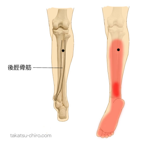 後脛骨筋のトリガーポイント関連痛領域