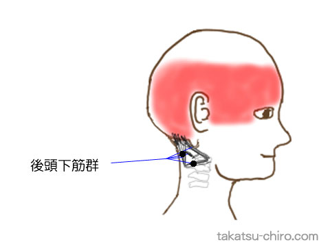 後頭下筋群のトリガーポイントの関連痛領域