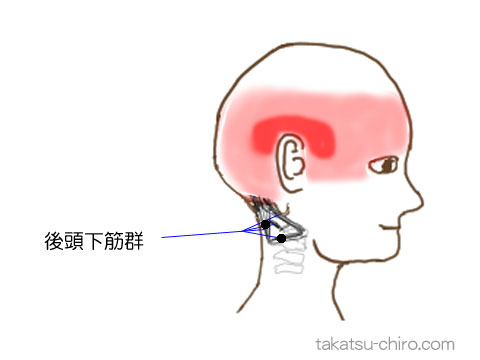 後頭下筋群のトリガーポイントの関連痛領域