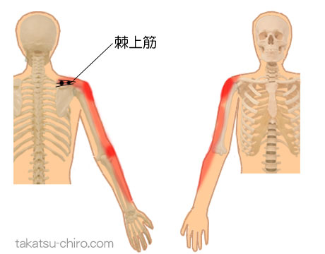 棘上筋のトリガーポイント関連痛領域