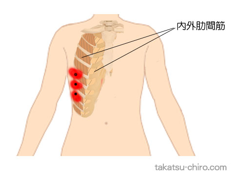 肋間筋のトリガーポイント関連痛領域