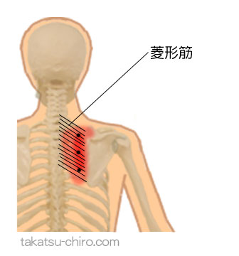 菱形筋のトリガーポイント関連痛領域
