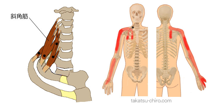 斜角筋のトリガーポイント関連痛領域