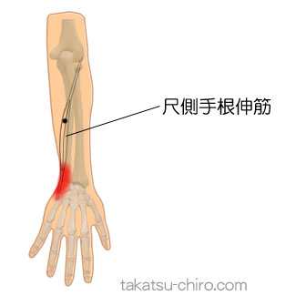 尺側手根伸筋のトリガーポイント関連痛領域