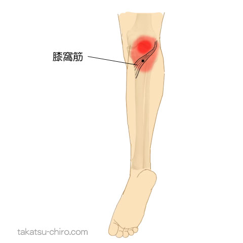 膝窩筋のトリガーポイント関連痛領域