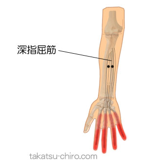 深指屈筋のトリガーポイント関連痛領域