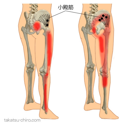 小殿筋のトリガーポイント関連痛領域