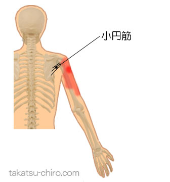 小円筋のトリガーポイント関連痛領域