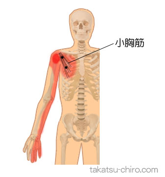小胸筋のトリガーポイント関連痛領域