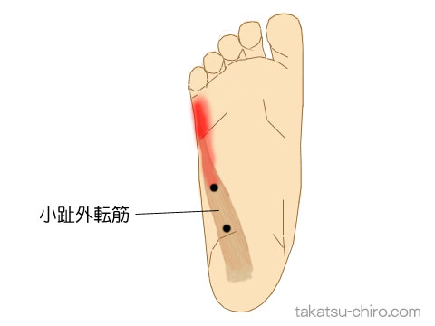 小趾外転筋のトリガーポイント関連痛領域