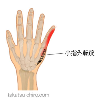 小指外転筋のトリガーポイント関連痛領域