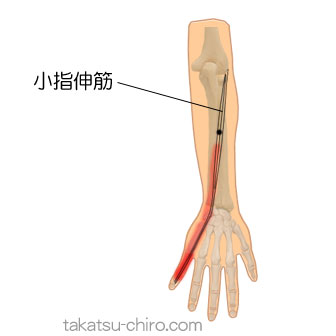 小指伸筋のトリガーポイント関連痛領域