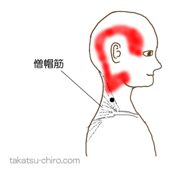 僧帽筋のトリガーポイント関連痛領域