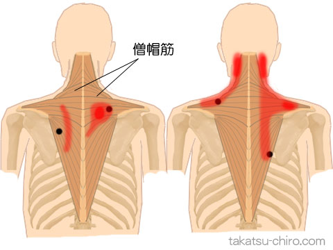 僧帽筋のトリガーポイント関連痛領域