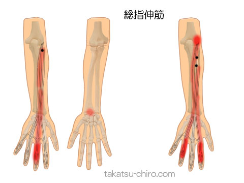 (総)指伸筋のトリガーポイント関連痛領域
