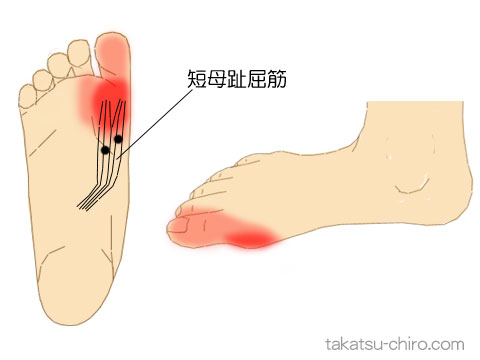 短母趾屈筋のトリガーポイント関連痛領域