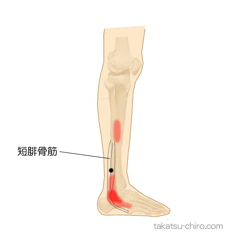 短腓骨筋のトリガーポイント関連痛領域