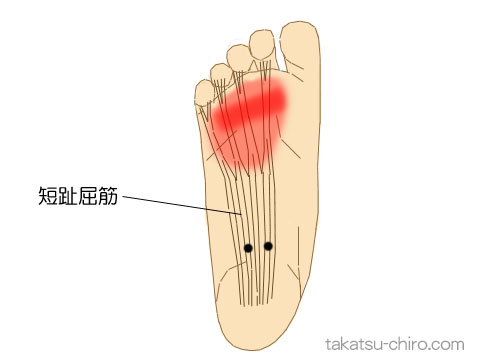 短趾屈筋のトリガーポイント関連痛領域
