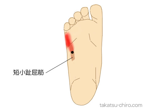 短小趾屈筋のトリガーポイント関連痛領域