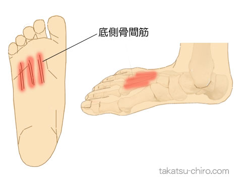 底側骨間筋のトリガーポイント関連痛領域