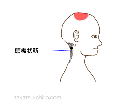 頭板状筋のトリガーポイント関連痛領域