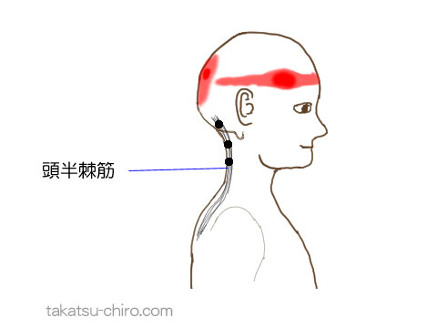 頭半棘筋のトリガーポイント関連痛領域
