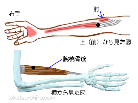 腕橈骨筋のトリガーポイント関連痛領域