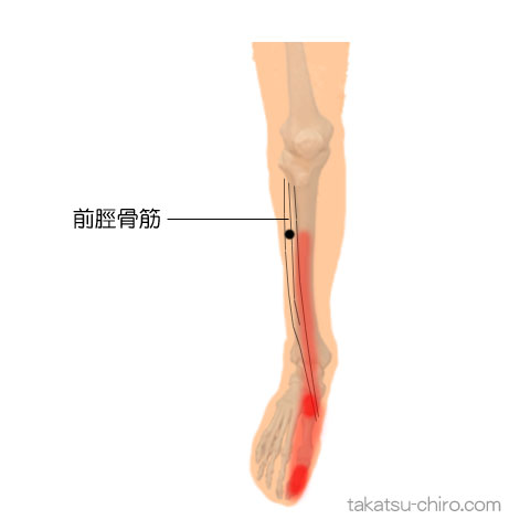 前脛骨筋のトリガーポイント関連痛領域