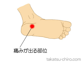 歩き出すとき左踵が痛い(症例)