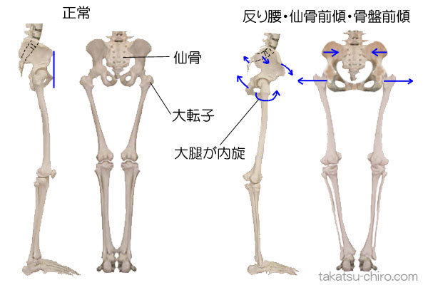 反り腰で骨盤が前傾すると大転子がより外側に移動する
