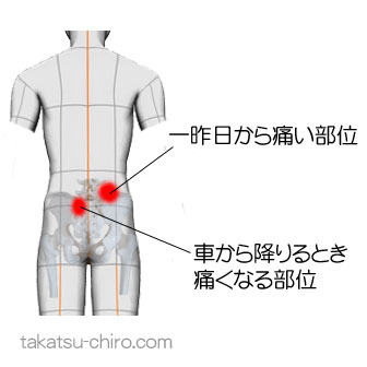 車から降りるとき腰が痛い（症例）