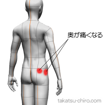 右大腿つけ根の外側や臀部に痛み（症例）