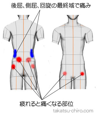 疲れると腰が張って痛い（症例）