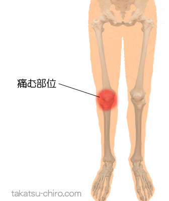 動きはじめに右膝(膝蓋骨周り)が痛む（症例）