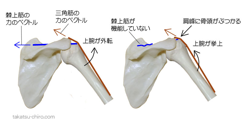 棘上筋と三角筋の不連動による肩関節の痛みと可動制限