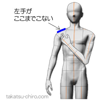 左手が右肩にとどかない（症例）