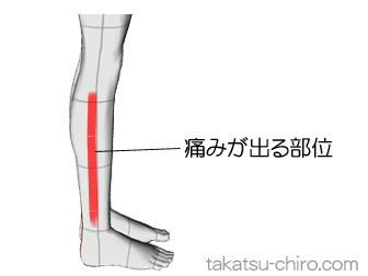 歩くと下腿の外側が痛くなる(症例)