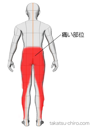 腰から尻、大腿後ろ、下腿後ろ外側が痛い（症例）