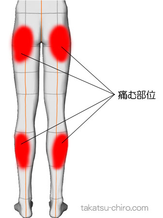尻とふくらはぎに、張るような痛み(症例)
