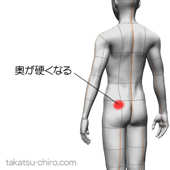座ってるとお尻の奥が硬くなり、左大腿の外側が張ってくる（症例）