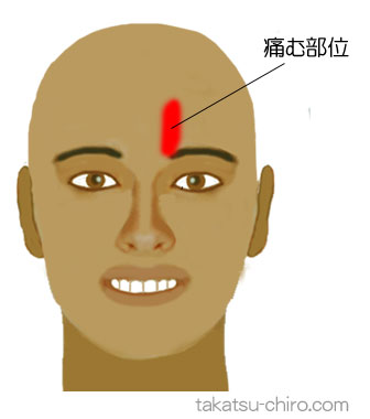 おでこのあたりの頭痛（症例）