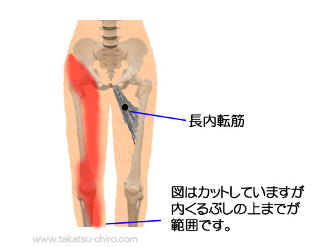 長内転筋トリガーポイントの関連痛領域