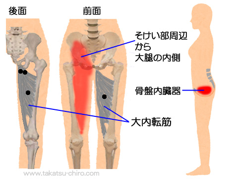 大内転筋トリガーポイントの関連痛領域