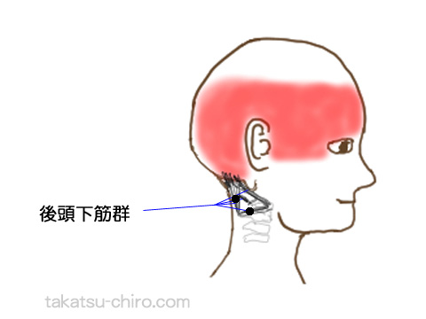 後頭下筋群のトリガーポイントの関連痛領域