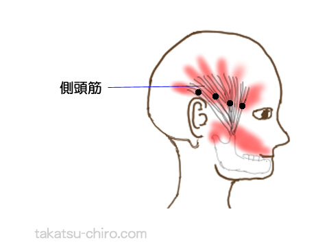 側頭筋トリガーポイントの関連痛領域